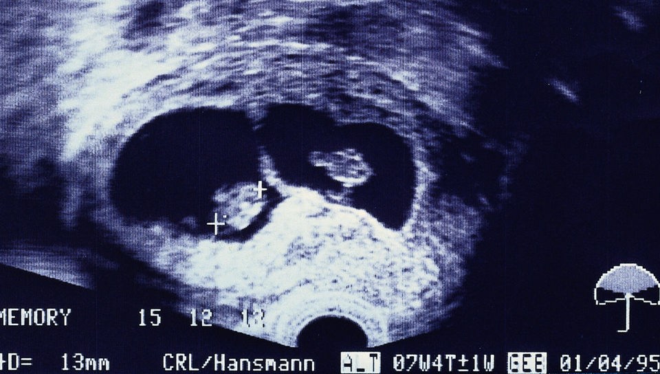 Ultraschallbild zeigt Schwangerschaft mit zweieiigen Zwillingen in der siebten Woche.