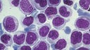 Mikroskopaufnahme der Blutkrebserkrankung "Chronische myeloische Leukämie".