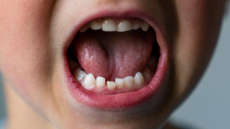 Aufgerissener Mund eines Kindes zeigt die Zähne.